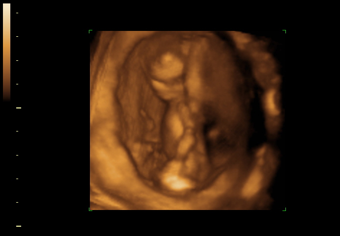 3D ultrasound image at 13 weeks
